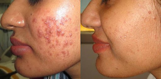 Acne / Pimples Treatment