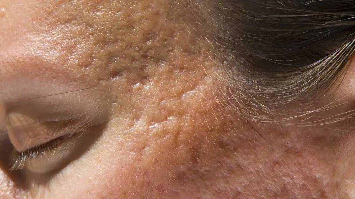 Acne / Pimple Scars Treatment
