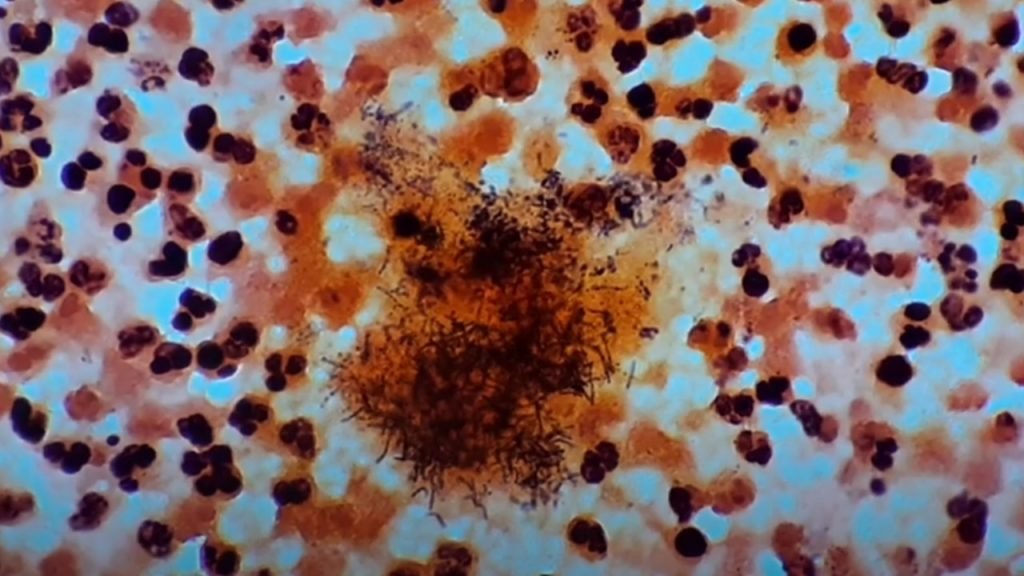 Actinomycosis Treatment