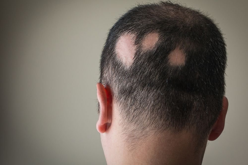 Hair Disease