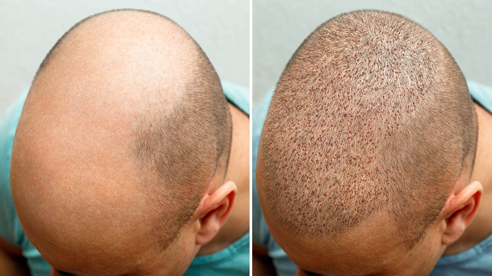 Hair Restoration