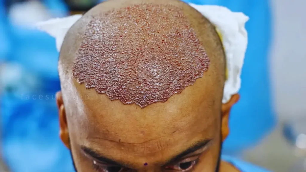 Hair Transplant Surgery