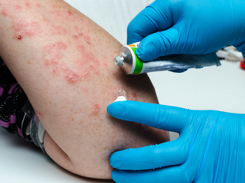 Skin Disease Treatment