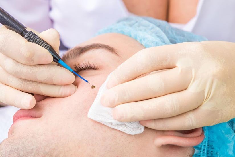 Skin Tag Surgical Removal