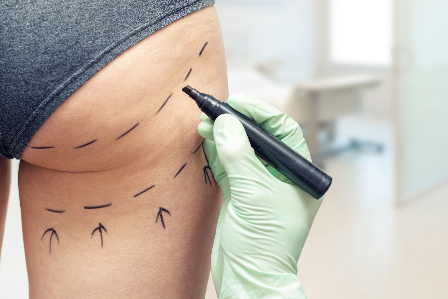 Thighplasty (Thigh Lift)