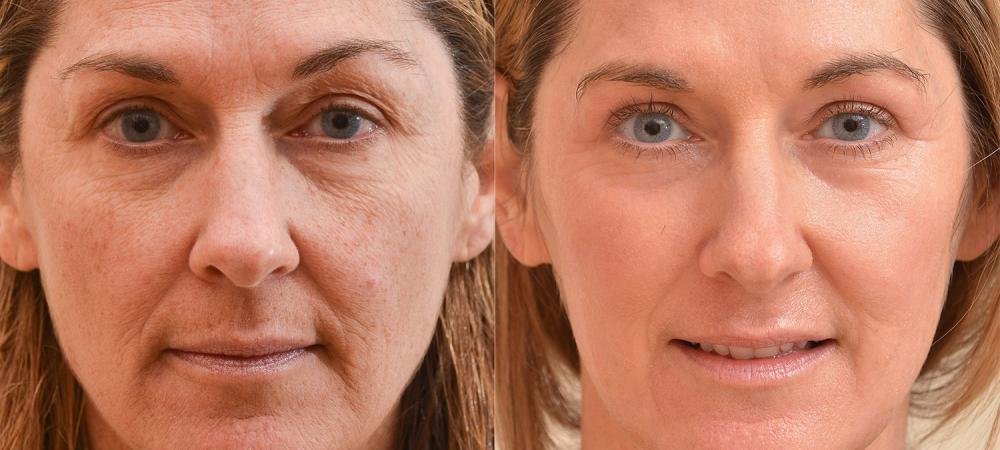laser resurfacing