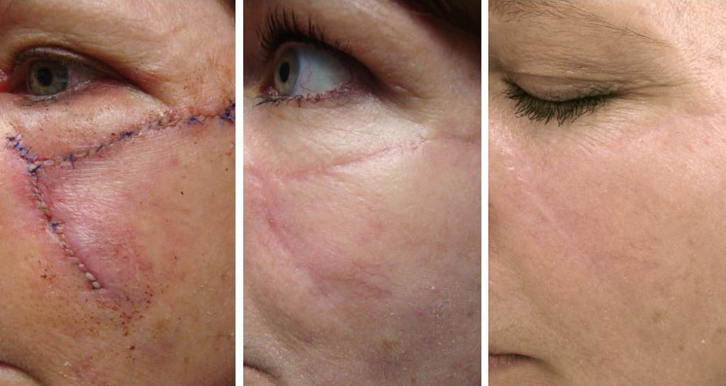 scar treatment