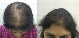 Biofibre Hair Implant