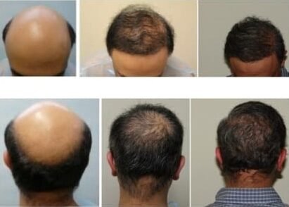 Hair Multiplication