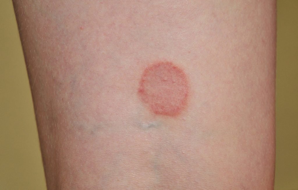 treatments for ringworm