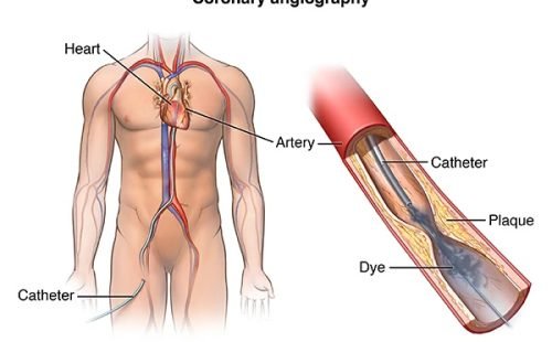 Angiography