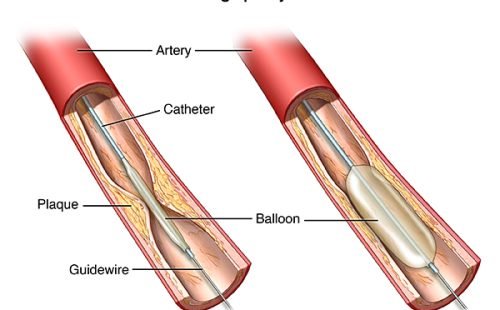 An inserted balloon catheter inflates to open blocked blood vessel; PCardio_20140402_v0_001

SOURCE: pickup from cardio_peri-vasc-angiopl_proc_3a;