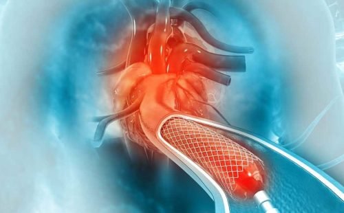 Complex Angioplasties