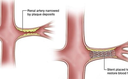 Renal Angiography and Renal Stenting